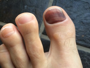 Ten awful things about running - Black Toenails